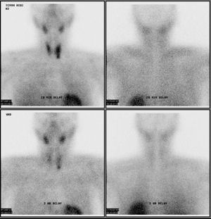 Figure of parathyroid scan provided by Dr Weiss