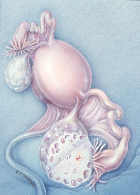 Illustration of polycystic ovary syndrome