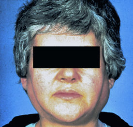 Parotid swelling in Sjogrens syndrome