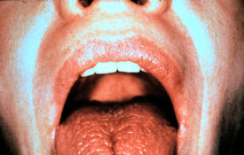 Dry mouth in Sjogrens syndrome