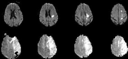less-thanbgreater-thanMRI in acute ischemic strokeless-thanslashbgreater-than Diffusion-weighted images top row demonstrate a small area of acute infarction andslashor cytotoxic edema in the left hemisphere Perfusion-weighted images bottom r