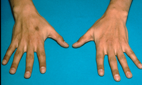Shown are the hands of a patient with Addisons disease Photo by PhotoTake