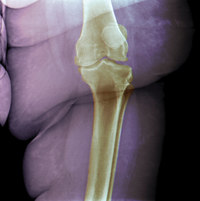 X-ray of the left knee frontal view showing osteoarthritis of the internal femorotibial joint in an obese 25-year-old female patient weighing 130 kg Photo  PDSNslashPhototake