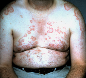 This patient has a rash in subacute cutaneous lupus erythematosus an annular polycyclic rash characterized by scaly erythematous circular plaques with central hypopigmentation Photo  American 