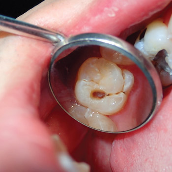 Preventive dental care may have an even greater impact among patients with a heavy disease burden Image by JHLee