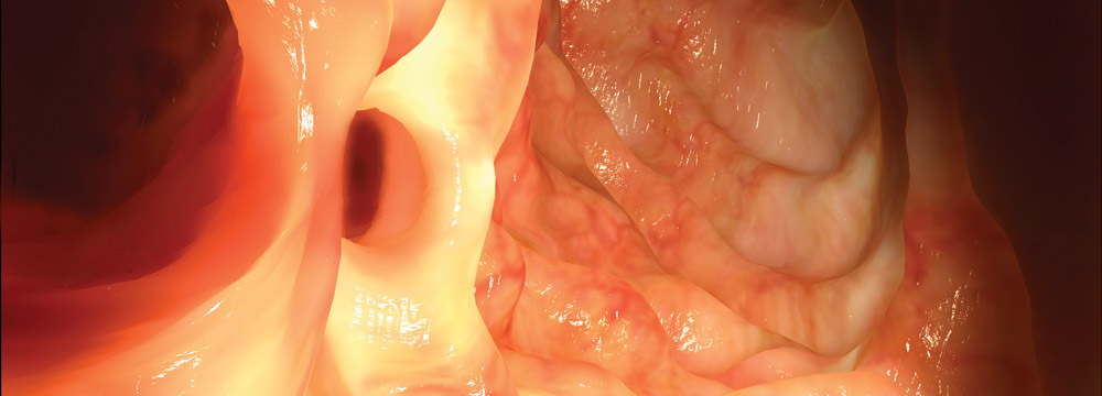 ACP suggests that clinicians initially manage most patients with acute uncomplicated left-sided colonic diverticulitis in an outpatient setting because of a lack of evidence suggesting a benefit of ro