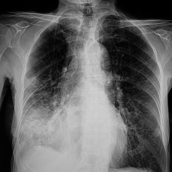 Isolating a pneumonia diagnosis can be challenging particularly for internal medicine physicians without easy access to a chest X-ray Image by SOPONE
