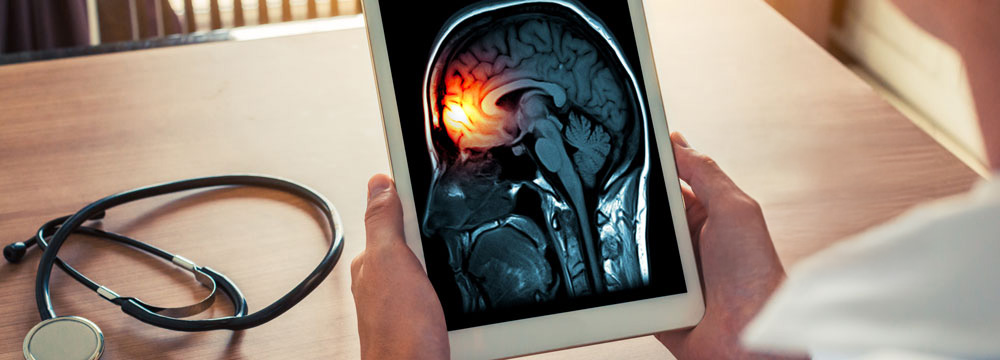 A new clinical practice guideline from ACP is designed to provide physicians with prescribing guidance for migraine prevention in nonpregnant adults based on high-quality studies Image by Adobe Stock